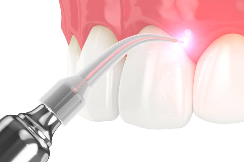Periodontal laser